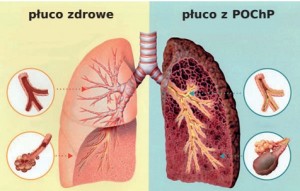 Przewlekła obturacyjna choroba płuc