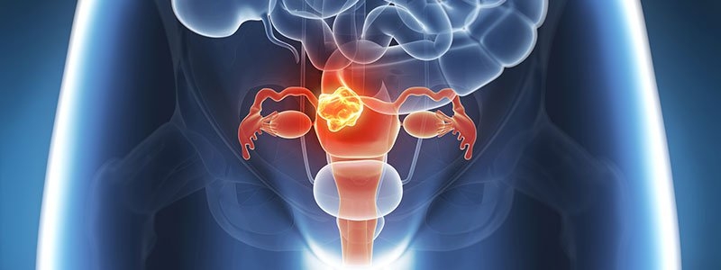CBD dla kobiet z endometriozą
