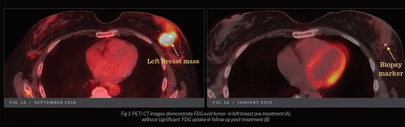 remisja raka piersi z przerzutami u 49-letniej pacjentki